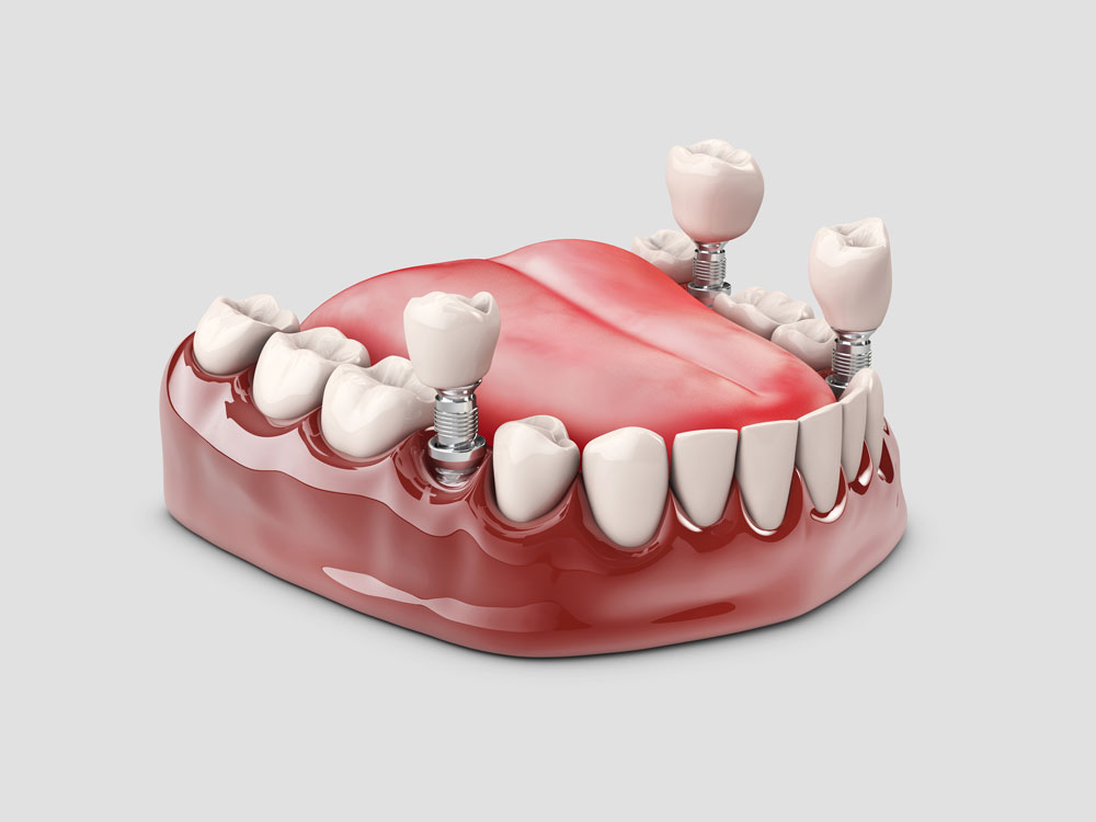Know Before Getting Teeth Implants