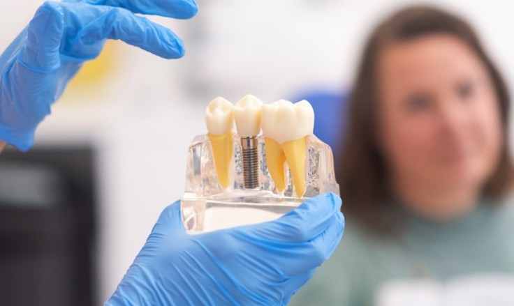 Coronas de confianza: El impacto de los implantes dentales