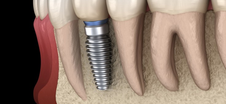 Entiende los beneficios de los All on Six implantes dentales