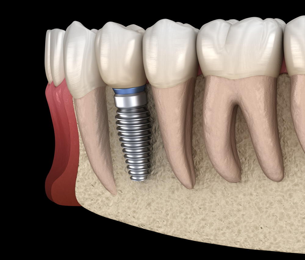 Entiende los beneficios de los All on Six implantes dentales