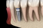 Renueva tu sonrisa: todo sobre los implantes dentales