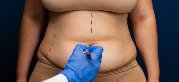 Abdominoplastia: Consejos de preparación y recuperación