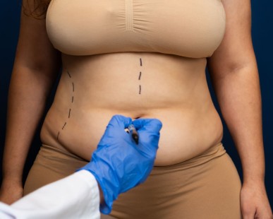 7 cosas que debe saber antes de someterse a una abdominoplastia