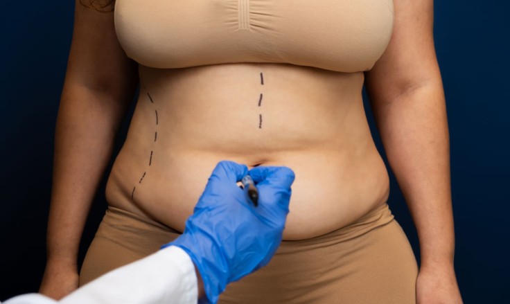 7 cosas que debe saber antes de someterse a una abdominoplastia