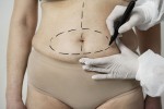 Mitos comunes sobre la abdominoplastia: lo que realmente necesitas saber