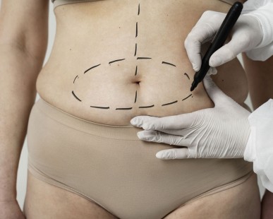 Everything You Need to Know About Abdominoplasty