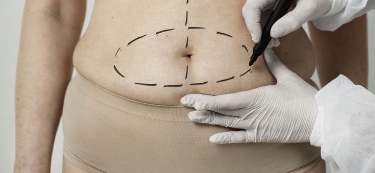 Mitos comunes sobre la abdominoplastia: lo que realmente necesitas saber