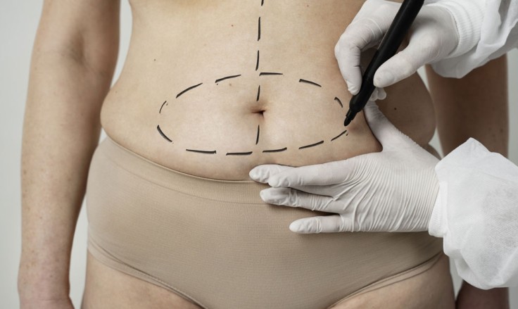 Mitos comunes sobre la abdominoplastia: lo que realmente necesitas saber