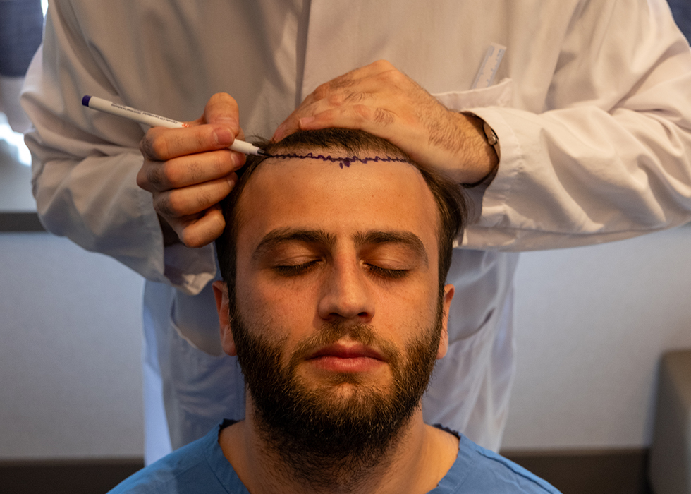 Hair Transplantation