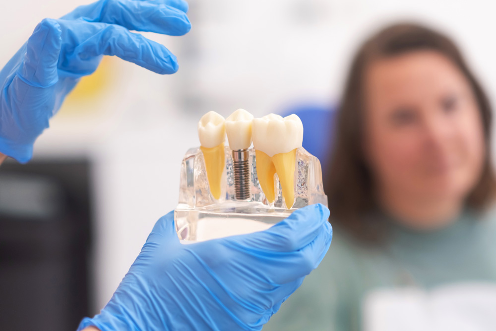 Everything You Need To Know About All On 6 Dental Implants In Turkey