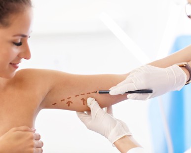 Arm Lift Surgery or Arm Liposuction: What's The Difference?