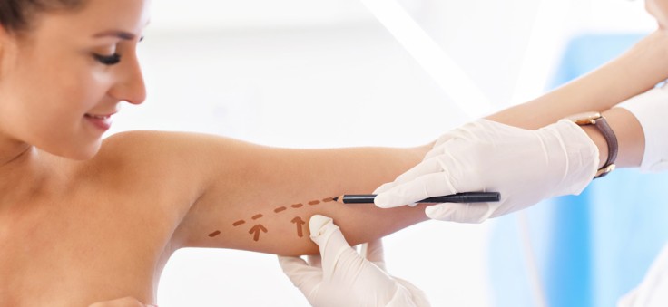 Arm Lift Surgery or Arm Liposuction: What's The Difference?