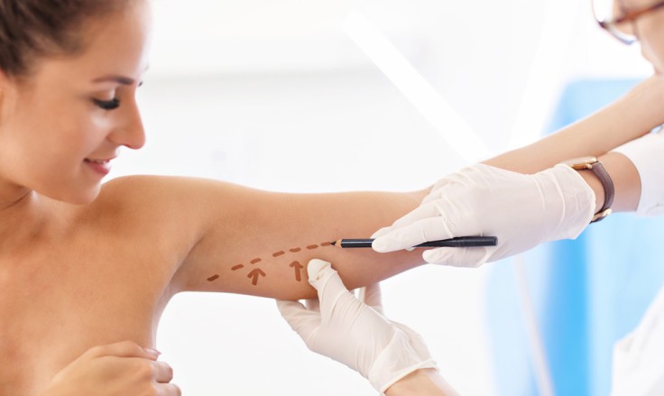 Arm Lift Surgery or Arm Liposuction: What's The Difference?