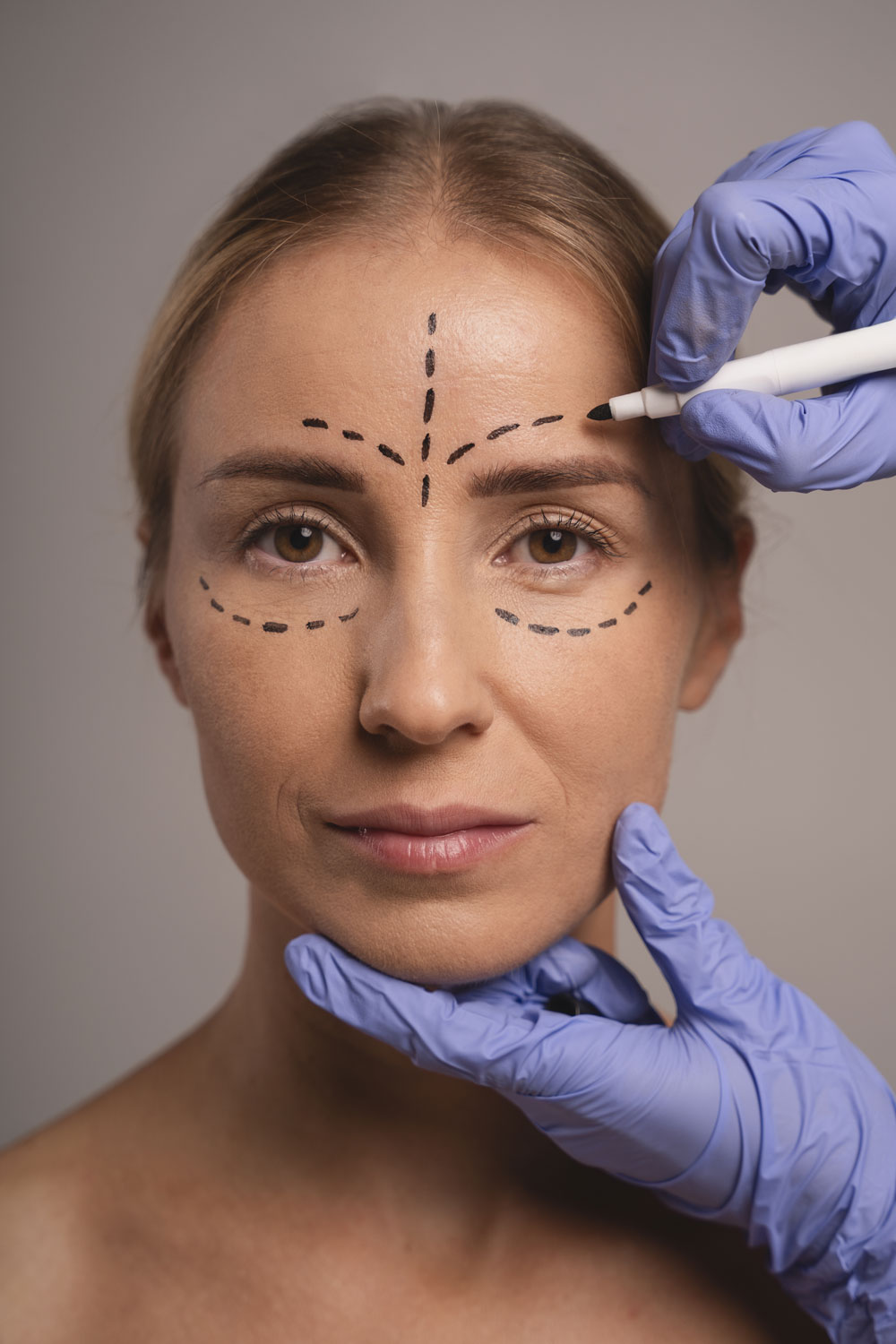 Cómo Prepararse para una Cirugía de Blefaroplastia