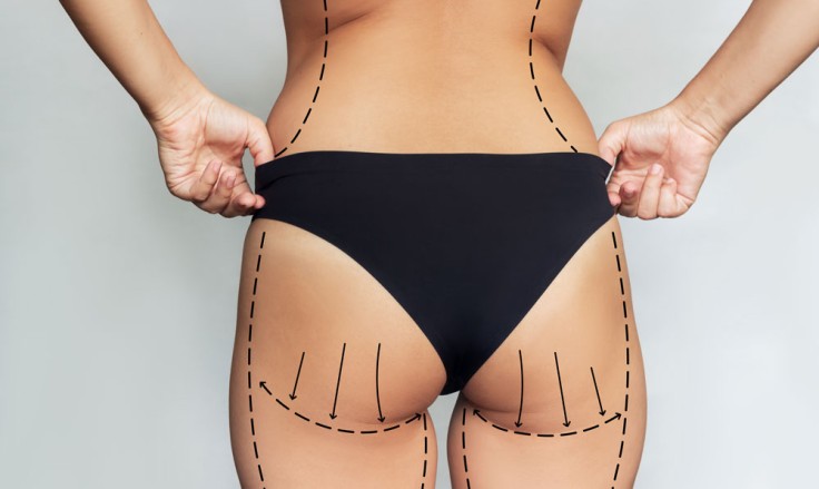 BBL vs. Butt Implants: Understanding the Long-Term Results