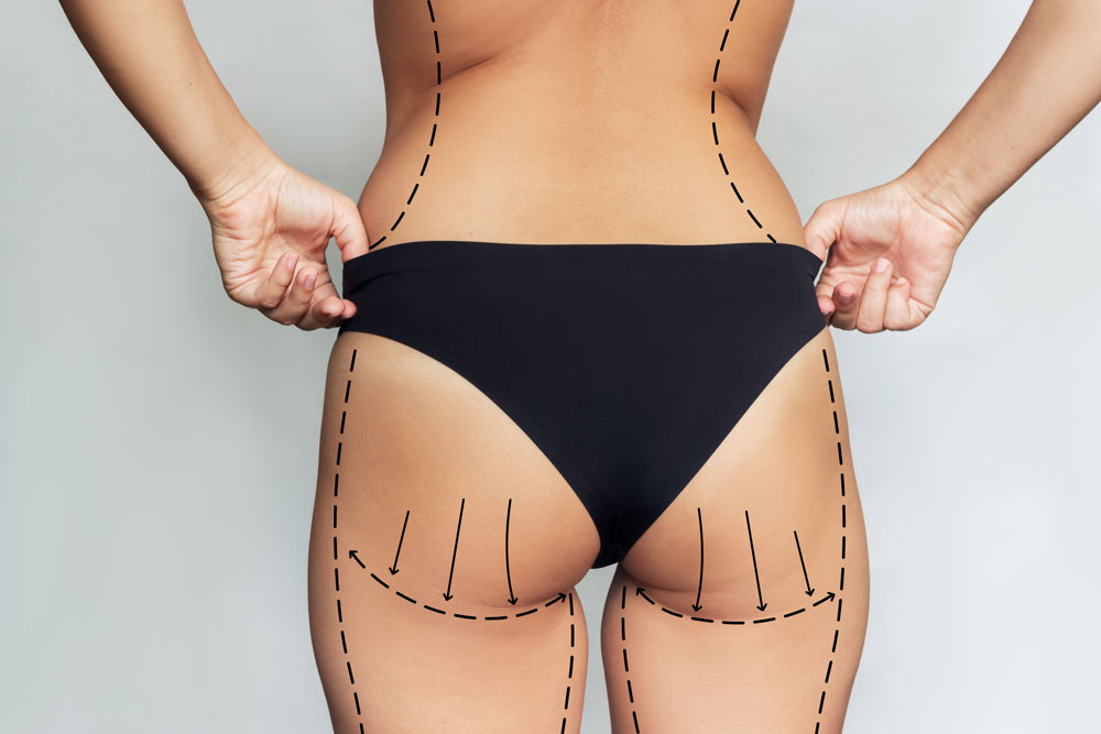 BBL vs. Butt Implants: Understanding the Long-Term Results