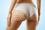 Everything You Need to Know Before Getting a Brazilian Butt Lift (BBL)