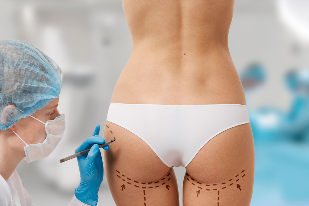 BBL vs. Butt Implants: Understanding the Long-Term Results