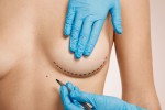 What to Expect from Breast Implant Replacement Surgery?