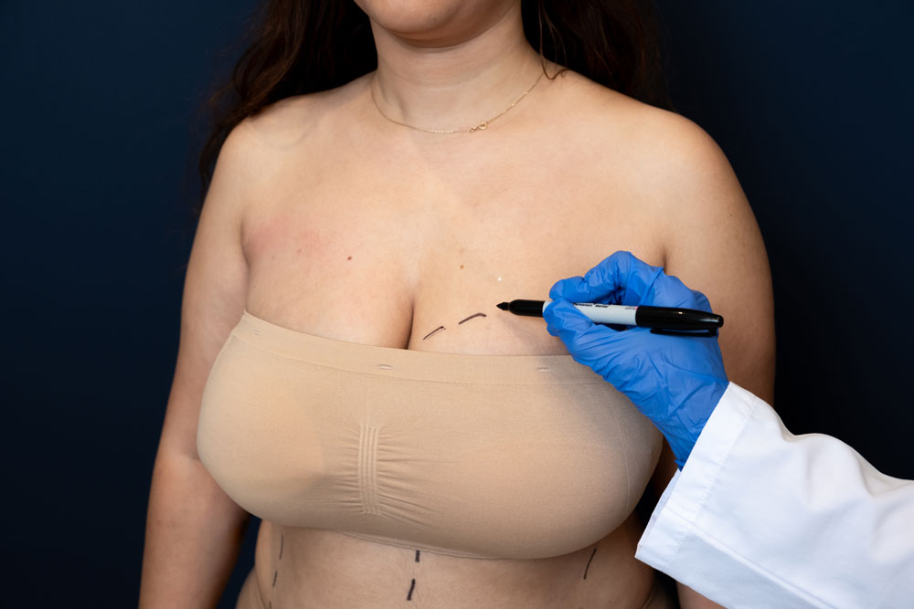 6 Reasons Why Breast Reduction Surgery Is Preferred In Turkey