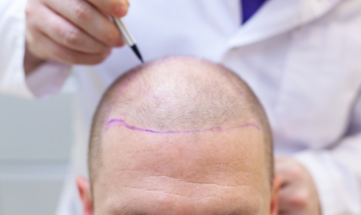 DHI vs. FUE: Which Hair Transplant Method Is Right for You?