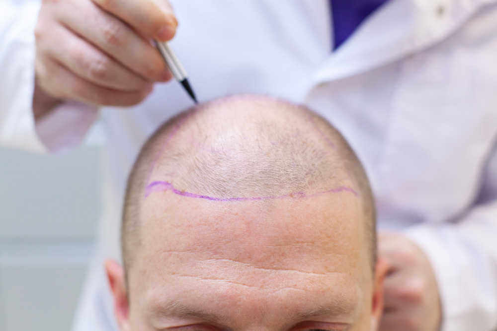 DHI vs. FUE: Which Hair Transplant Method Is Right for You?