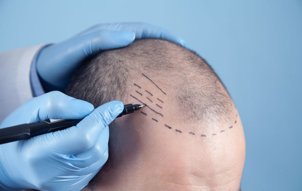 What Is The Overall Cost of a DHI Hair Transplant in Turkey?