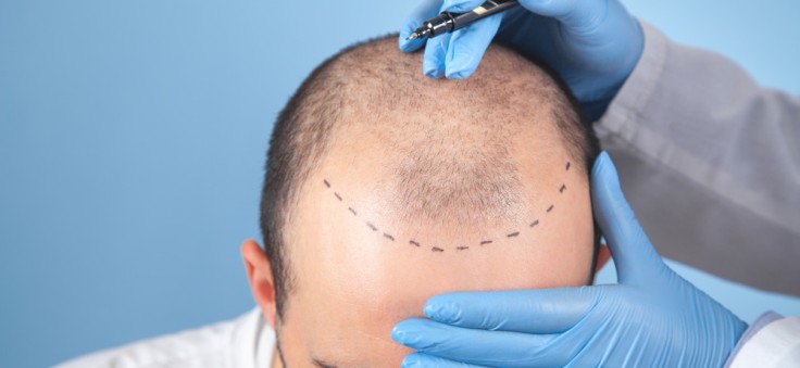 Wie Sie Ihr Haar nach einer Haartransplantation richtig pflegen