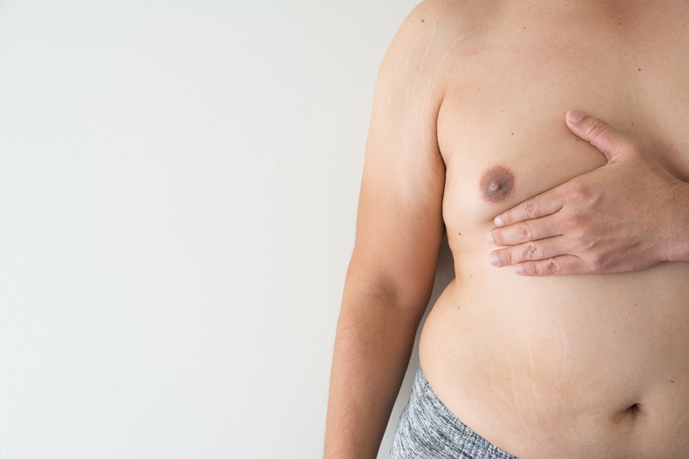 How Do You Know If You Need Gynecomastia Surgery?