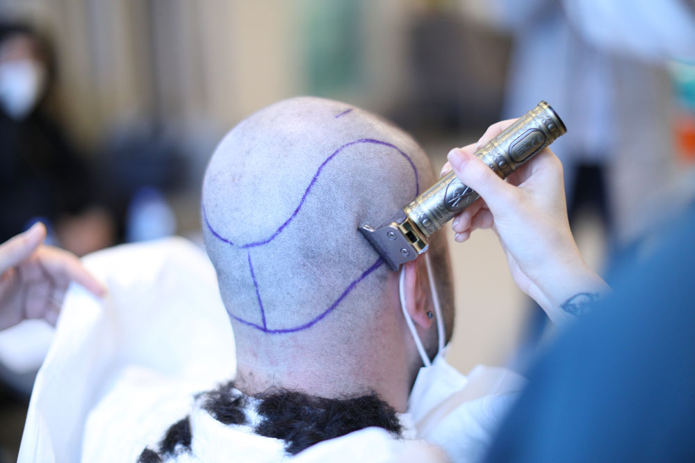 Haartransplantation in der Türkei