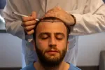 Top Tips for Maintaining Hair Transplant Results Long-Term