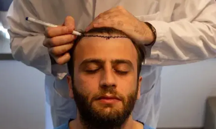 Top Tips for Maintaining Hair Transplant Results Long-Term