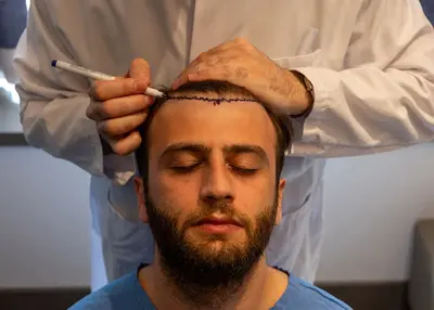 Hair Transplantation