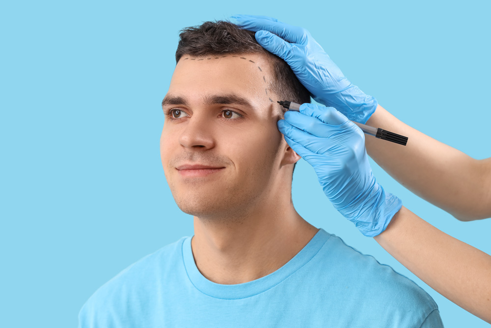 What You Need to Know About Hair Transplant?