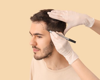 What You Need to Know About Hair Transplant?