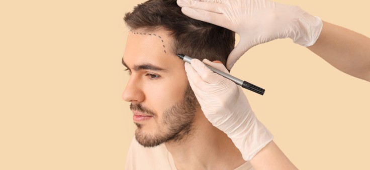 What You Need to Know About Hair Transplant?