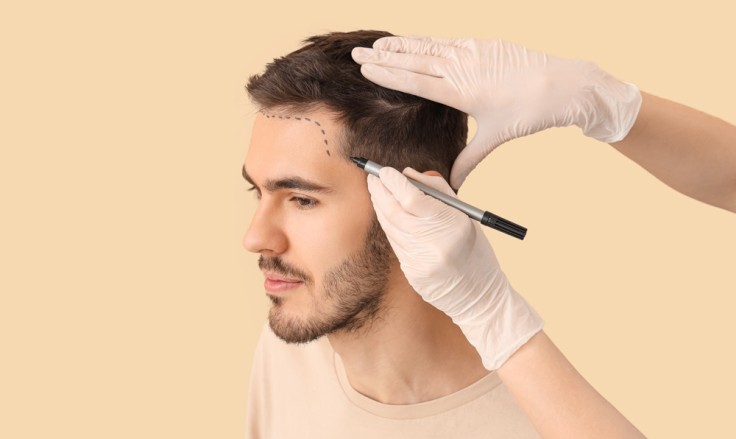 What You Need to Know About Hair Transplant?