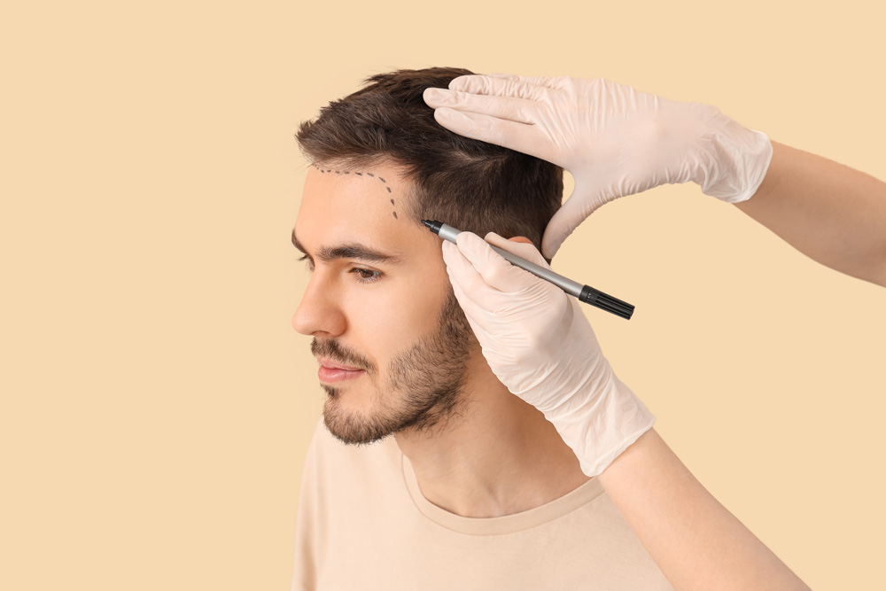 What You Need to Know About Hair Transplant?