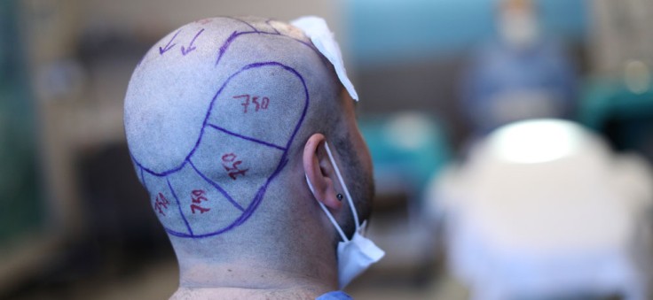 What to Do Before a Hair Transplant in Turkey?