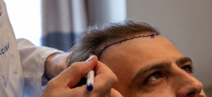 Wie pflegt man sein Haar nach einer Haartransplantation?