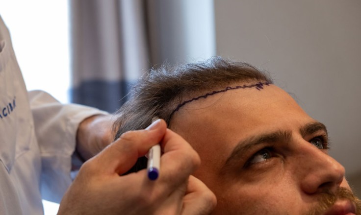 A Complete Guide to Post Hair Transplantation Care