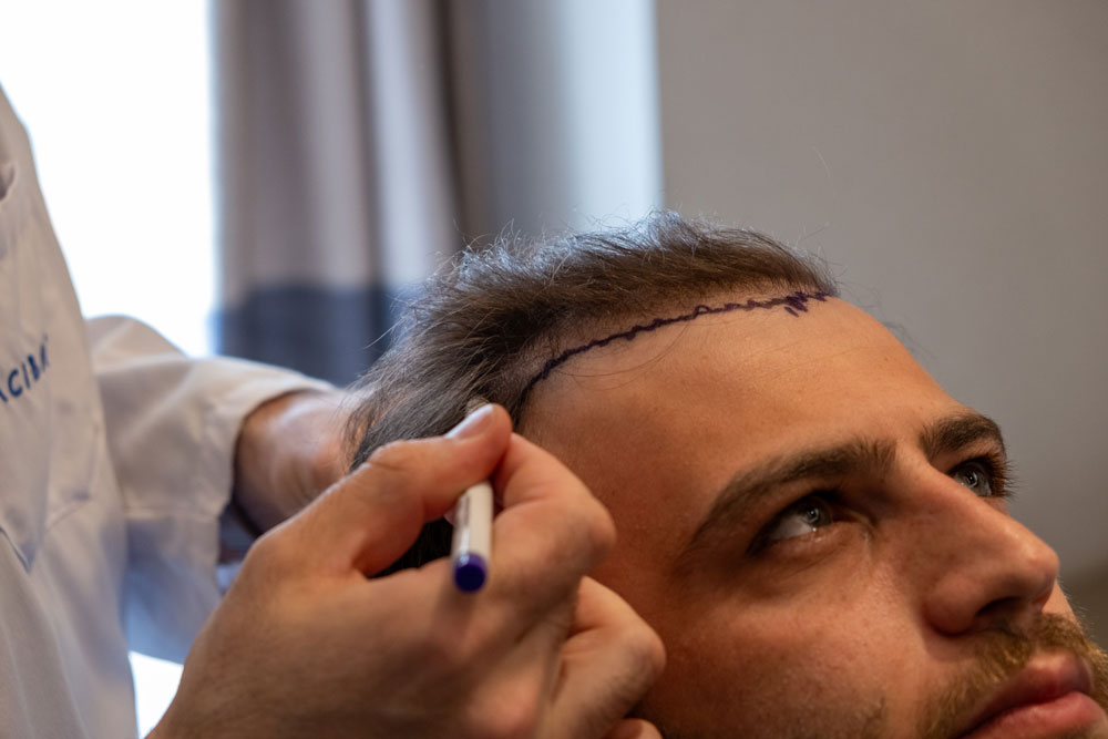 A Complete Guide to Post Hair Transplantation Care