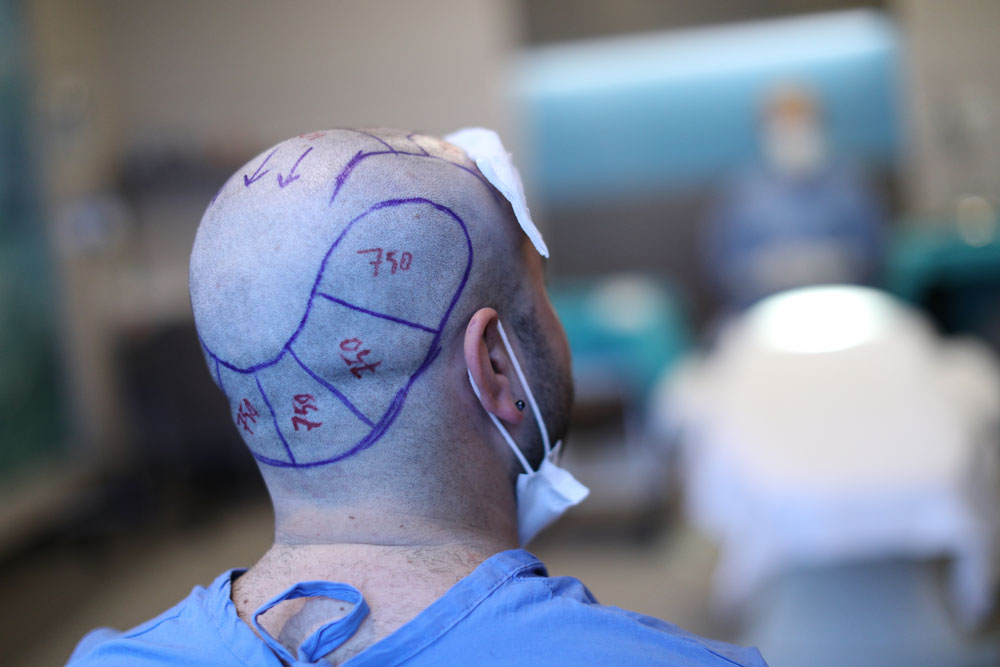 El arte de diseñar una línea de cabello en el procedimiento de injerto capilar