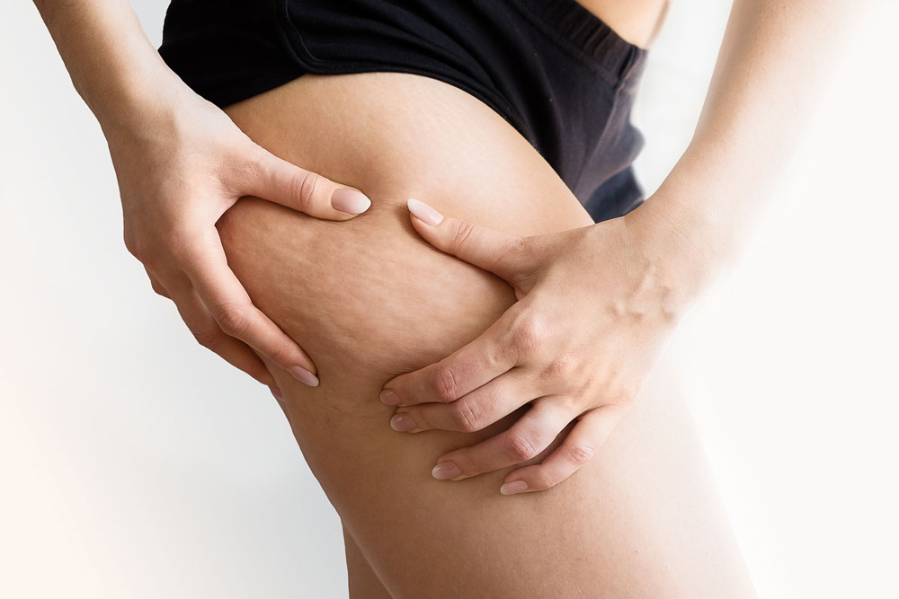 Lipedema Treatment