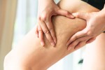 What You Need to Know Before Lipedema Treatment