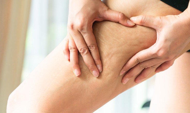 What You Need to Know Before Lipedema Treatment