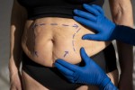 8 Tips for a Faster Recovery After Liposuction