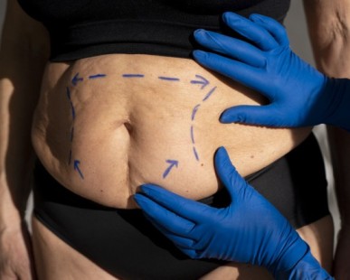 8 Tips for a Faster Recovery After Liposuction