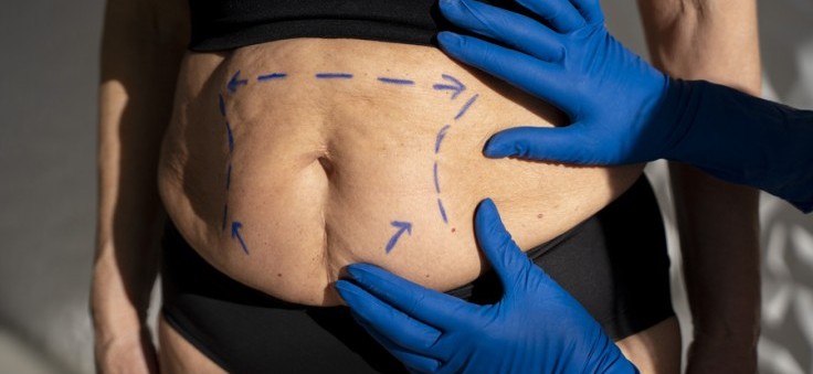 8 Tips for a Faster Recovery After Liposuction