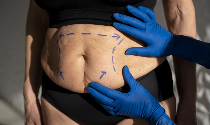 What are the Advantages of Liposuction in Turkey?